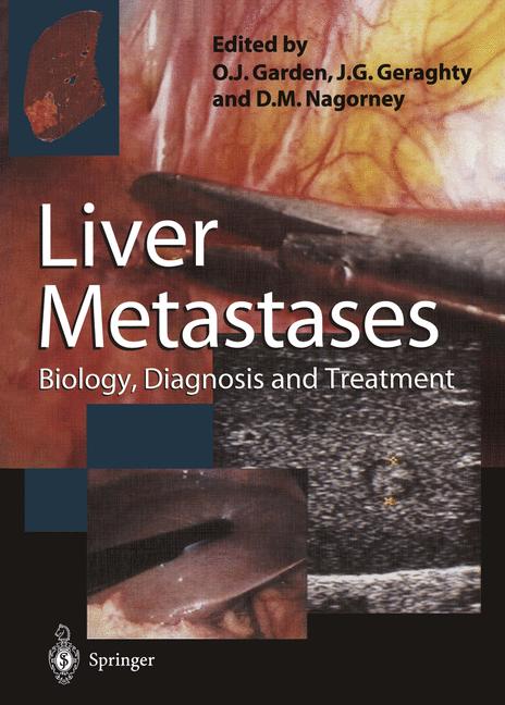 Liver Metastases - image