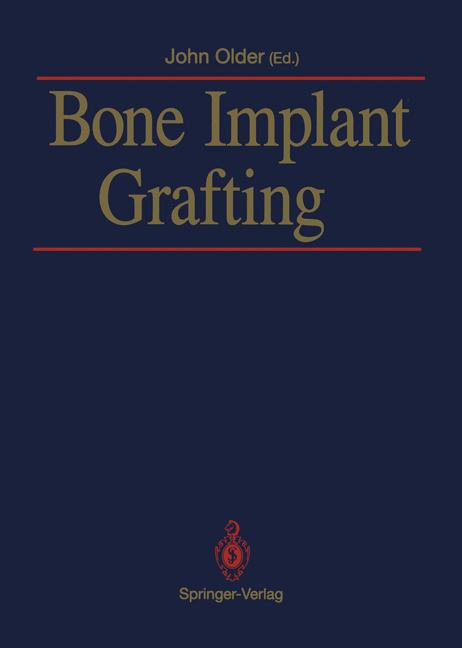 Bone Implant Grafti…