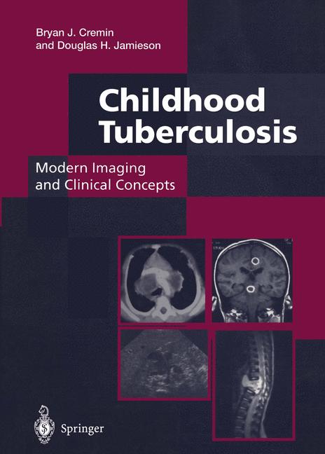 Childhood Tuberculo… - image