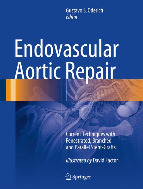 Endovascular Aortic… - image