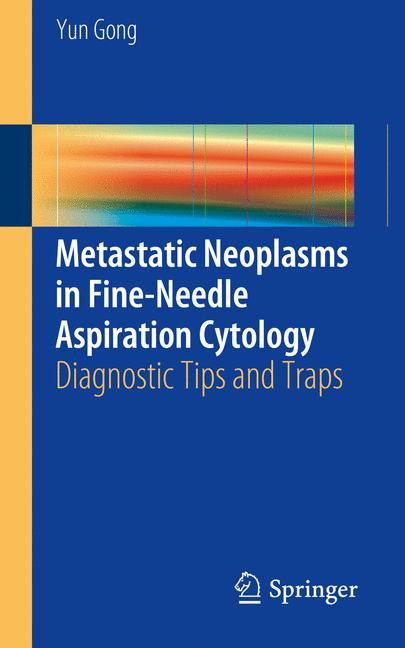 Metastatic Neoplasm…