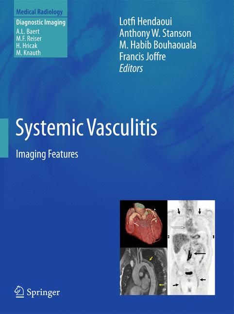 Systemic Vasculitis - image
