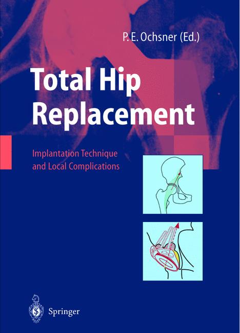 Total Hip Replaceme… - image