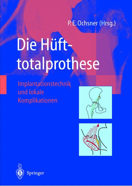 Die HÃ¼Fttotalproth…