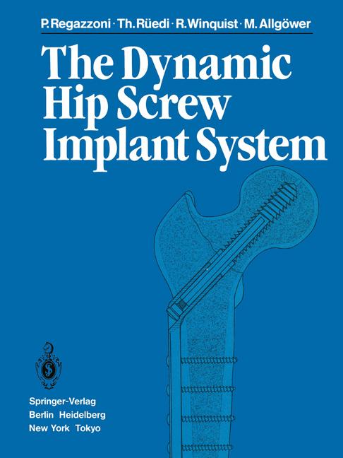 ISBN 9783642699276 product image for The Dynamic Hip Screw Implant System | upcitemdb.com