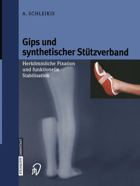 Gips Und Synthetischer StÃ¼Tzverband