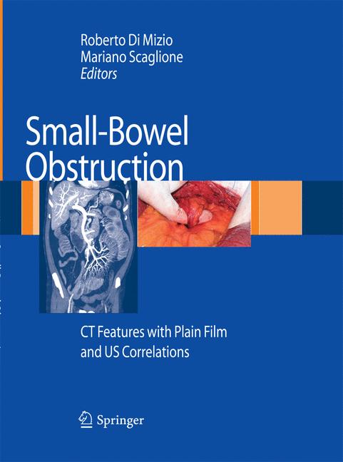Small-Bowel Obstruc… - image